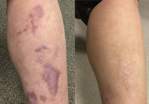 Can Laser Treatment Really Leave Scars?