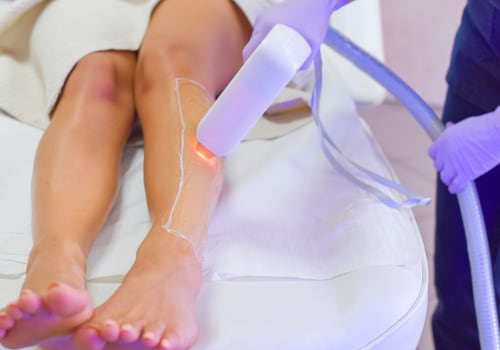 Achieving Optimal Results with Laser Hair Removal